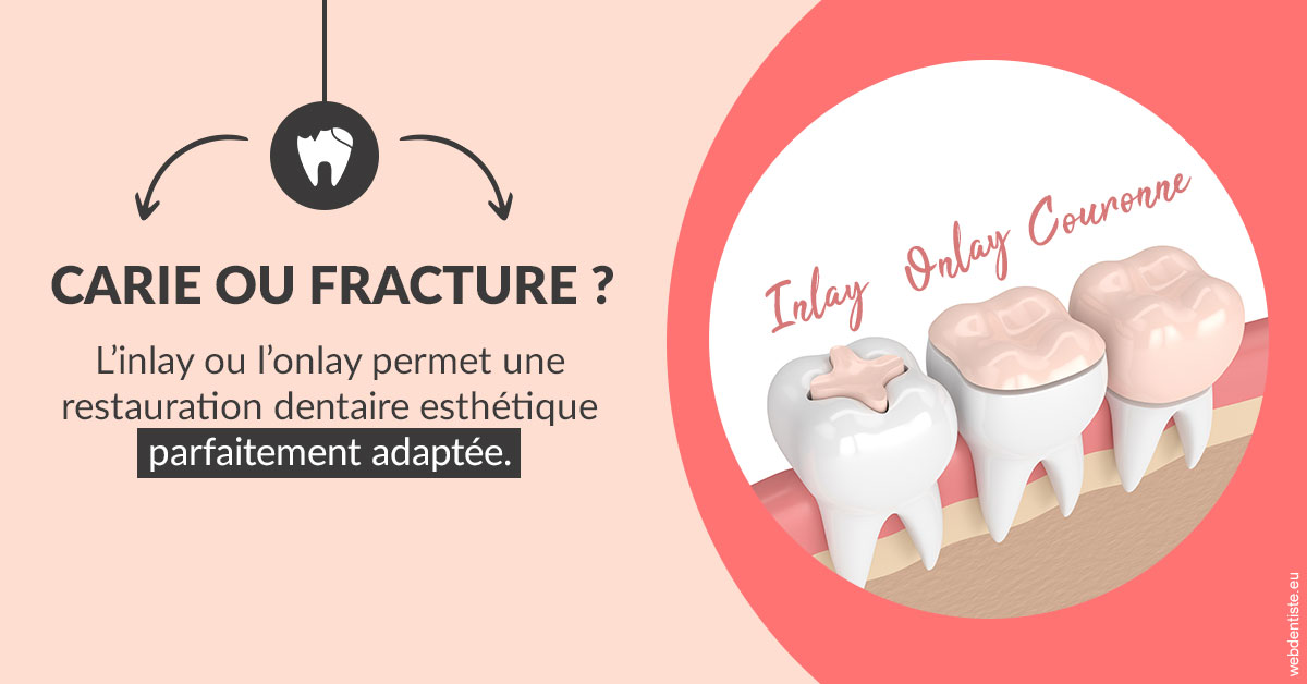 https://dr-poty-luc.chirurgiens-dentistes.fr/T2 2023 - Carie ou fracture 2