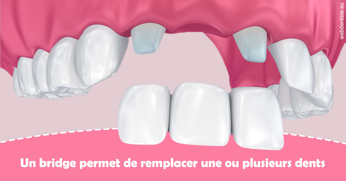 https://dr-poty-luc.chirurgiens-dentistes.fr/Bridge remplacer dents 2