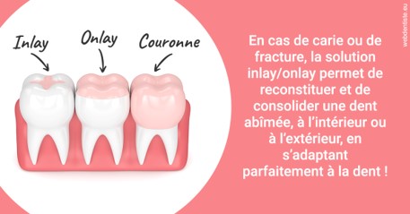 https://dr-poty-luc.chirurgiens-dentistes.fr/L'INLAY ou l'ONLAY 2