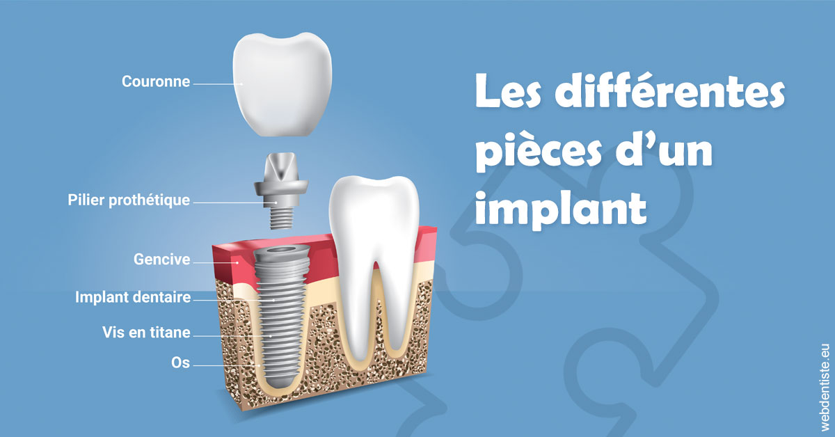 https://dr-poty-luc.chirurgiens-dentistes.fr/Les différentes pièces d’un implant 1