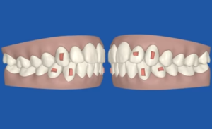 Invisalign clincheck orthodontie sherbrooke